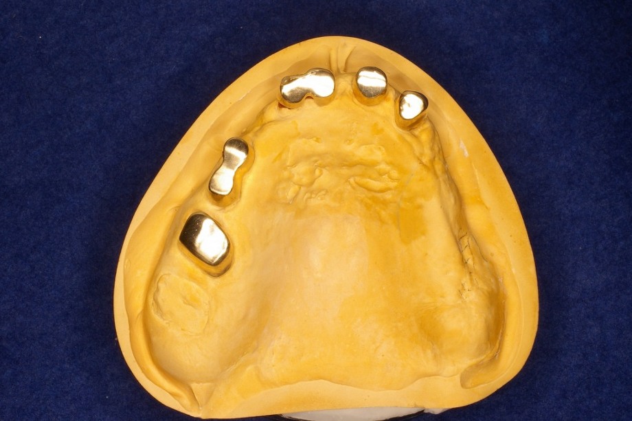 コーヌステレスコープ義歯02